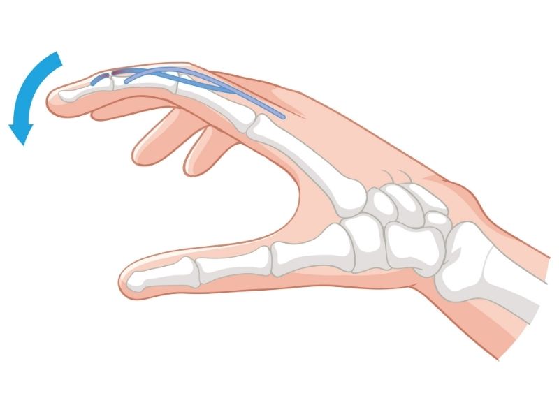 fleksor-tendon-yaralanmalari-belirtileri-nelerdir