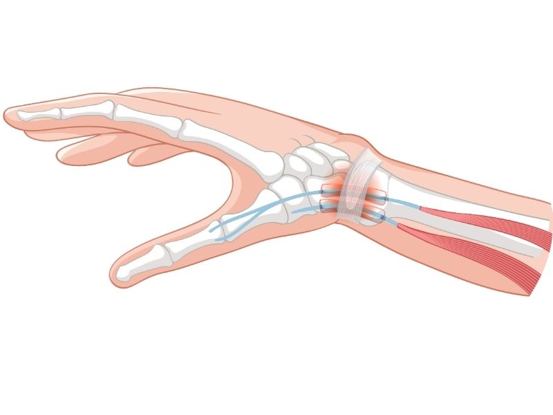 karpal-tunel-sendromu-belirtileri-nelerdir