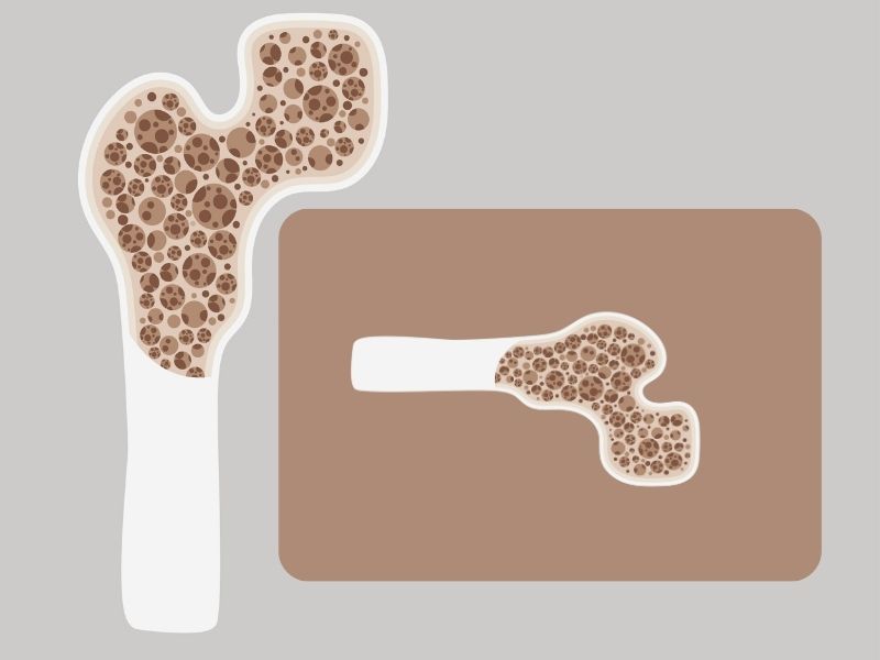 kemik-erimesi-tedavisi