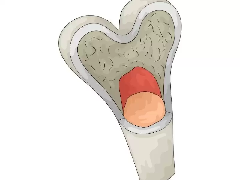 kemik-tumorleri-nelerdir-kemik-tumoru-tani-ve-tedavileri-nelerdir