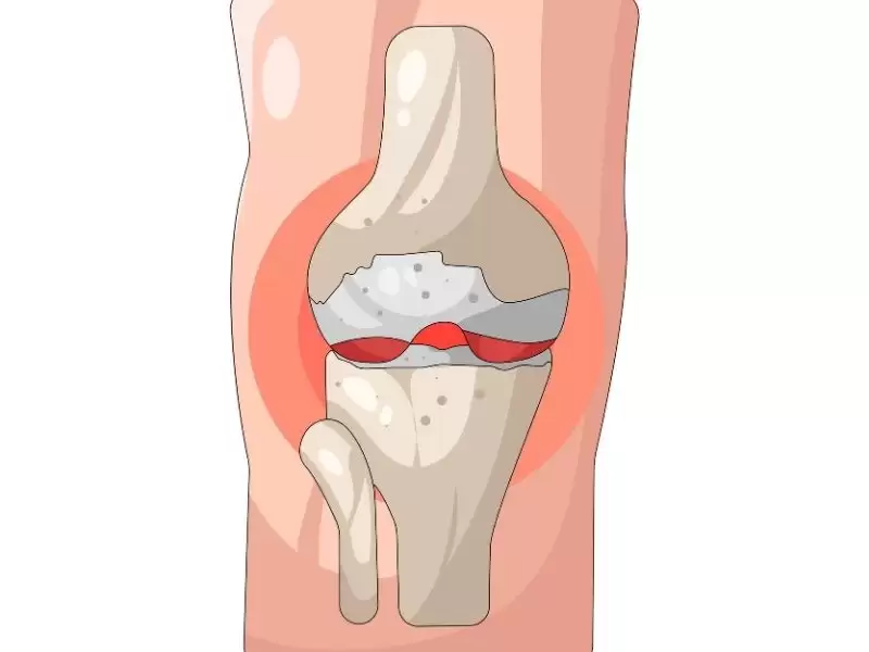 meniskus-yaralanmasi-nedir