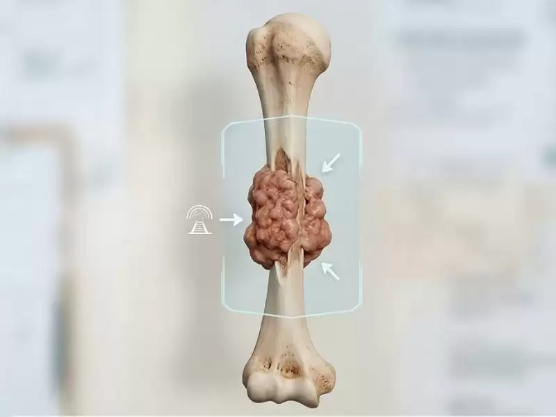 osteosarkom-kemik-kanseri